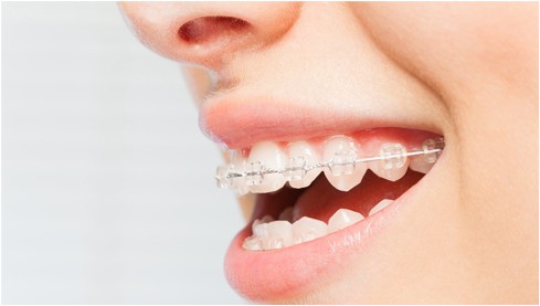 A woman's big smile is showcasing the ceramic braces done by 4 square dentistry