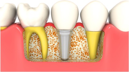 Dental implants and teeth visualized in 3D graphical model