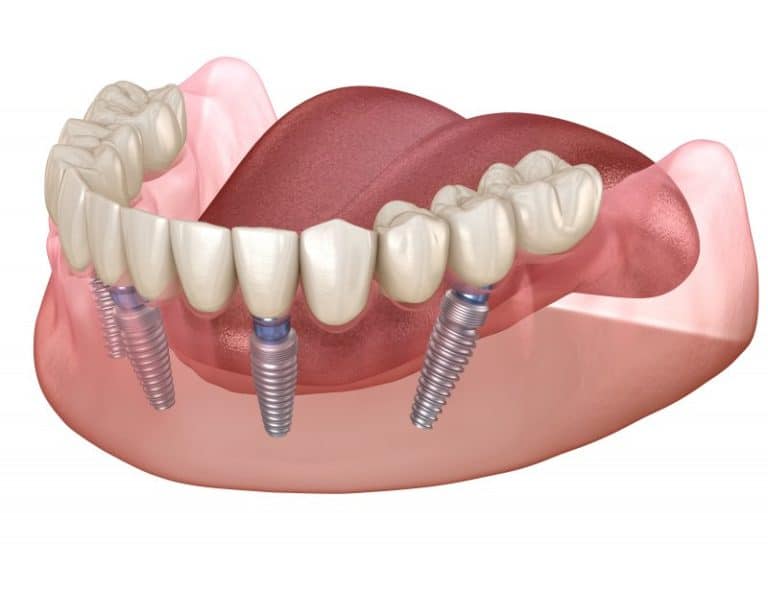 immediate full mouth dental implants