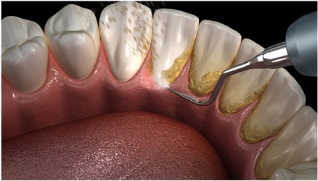 Panoramic view of lower jaw showing plaque buildup and damaged gums because of Gingivitis to be treated at 4SquareDentistry