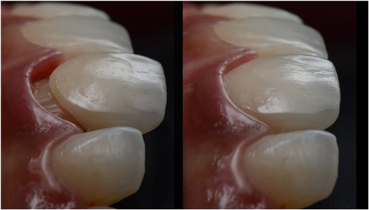 A closeup of periodontitis affected teeth - gum infection in teeth