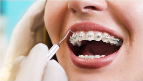 Close up of orthodontist's hands using dental forceps while examining metallic braces of a woman