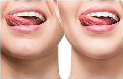 Women touching whitened and perfectly aligned teeth with their tongues