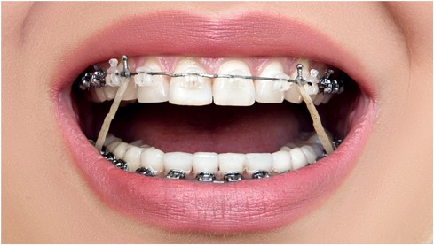 A closeup picture of a girl with self ligating braces shown after procedure at 4 square dentistry.