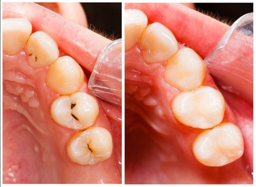 Before and after images showing teeth with amalgam fillings and ceramic onlay work at 4SquareDentistry, Medavakkam, Chennai