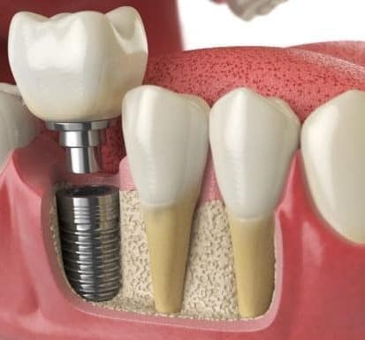 A 3D rendering of a dental implant