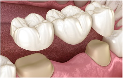 A 3D illustration of a dental crown bridge covering the damaged teeth