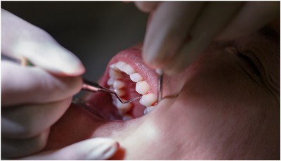 A patients softtissue in gums are examined with probe treated by 4square dentistry