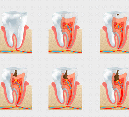 A visual explanation of root canal infection stages
