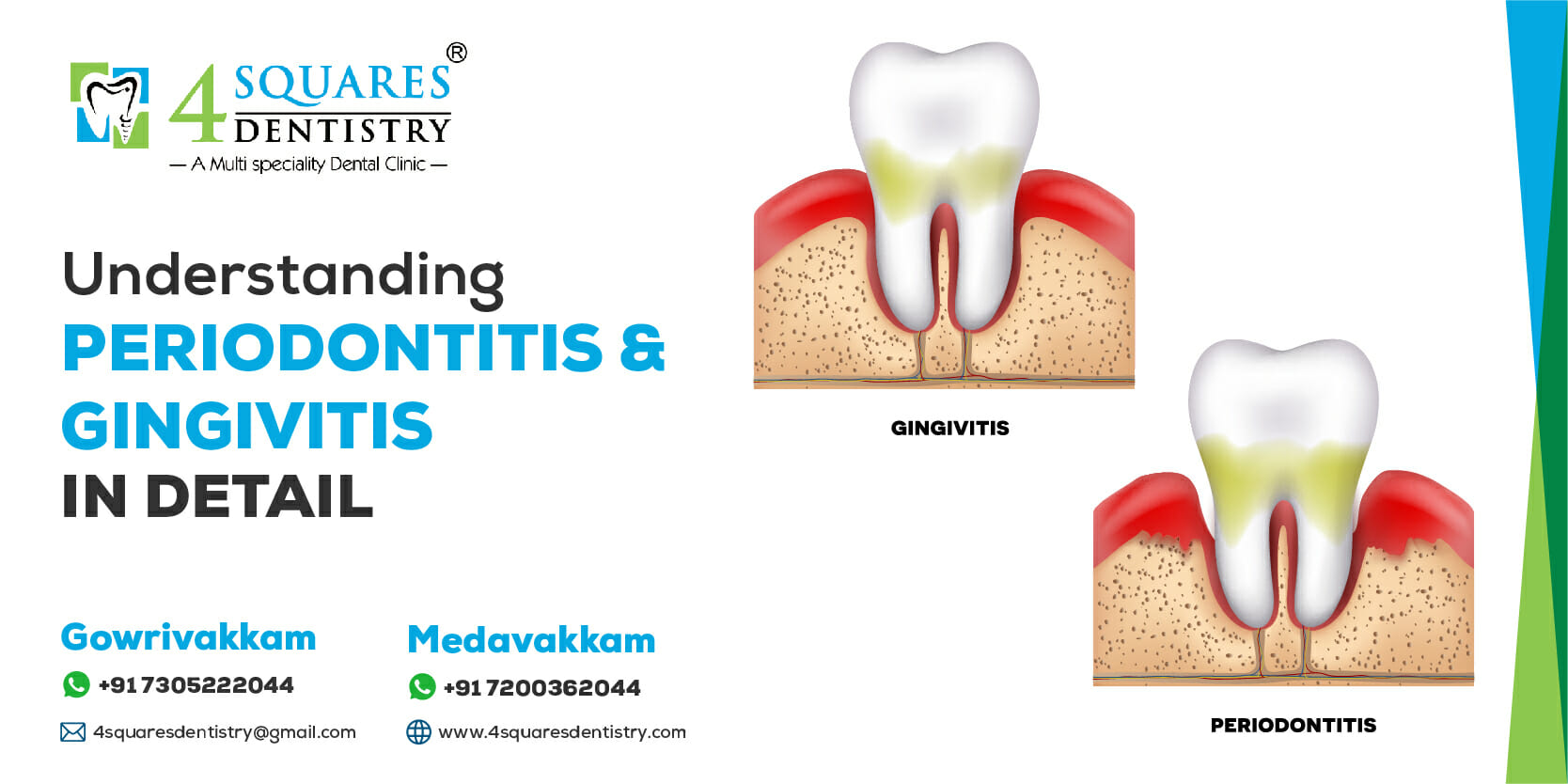 the logo and brand name of 4Squares Dentistry placed at top left corner with the text 'Understanding Gingivitis and Periodontitis in Detail' below the logo, the contact details for 4Squares Dentistry, Medavakkam and Gowrivakkam at the bottom left and 2 images of teeth, one affected by gingivitis(gum infection) and the other by periodontitis(advanced gum disease) on the right