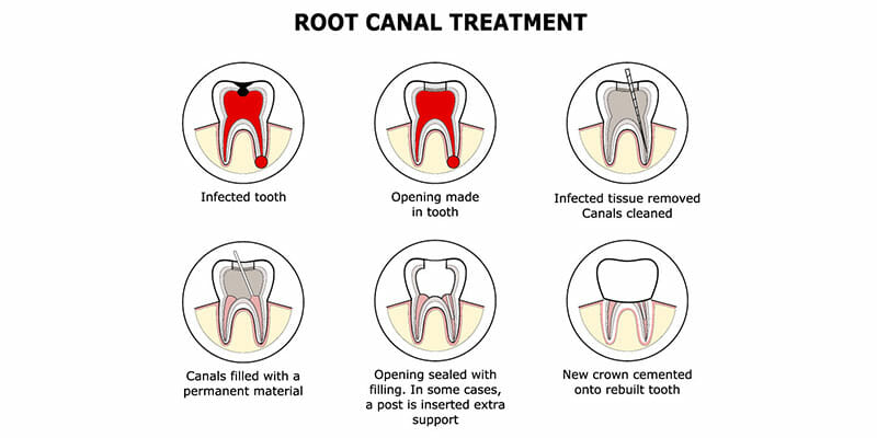 Vector representation of a root canal treatment and its procedure.