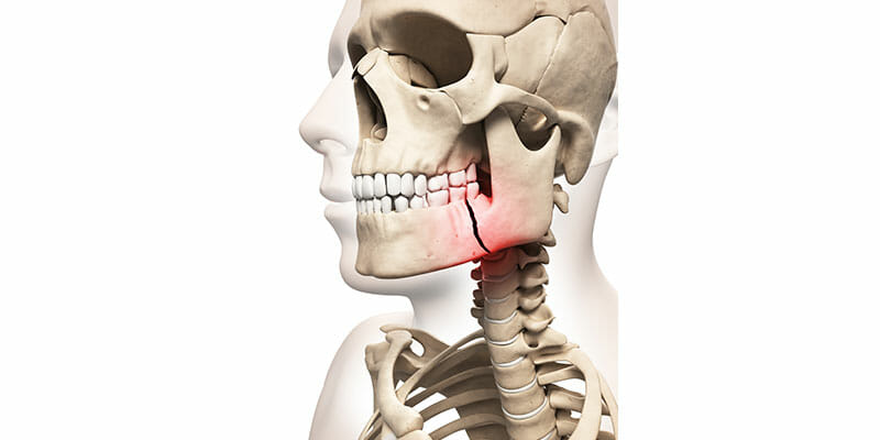Medical illustration of broken jaw bone.